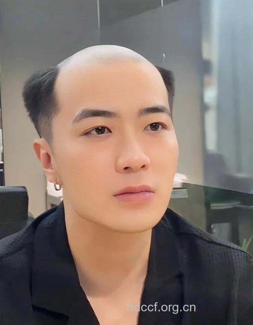 脱发让小伙子情何以堪