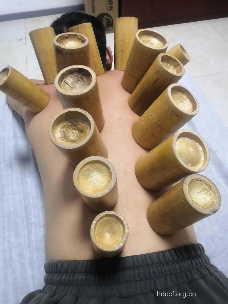 有哪些常用的火罐?