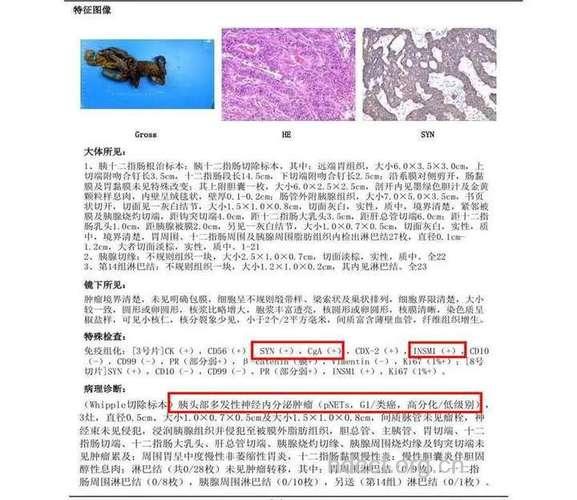 惊!胰头长瘤被误诊为精神病