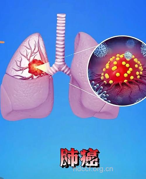 肺癌凭什么成为癌症之首