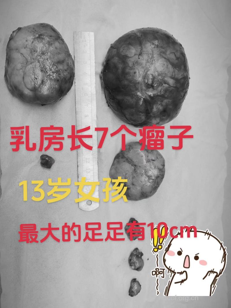 13岁的小女孩竟患上乳腺肿瘤
