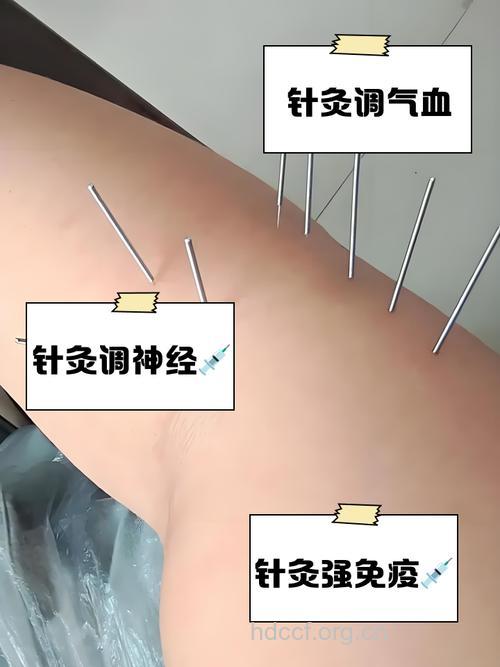 哪些体质的人适合针灸？