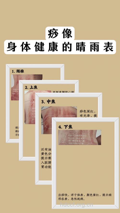 你知道怎么判断刮痧效果吗？