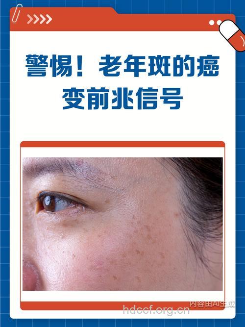 夏季老人警惕老年斑癌变