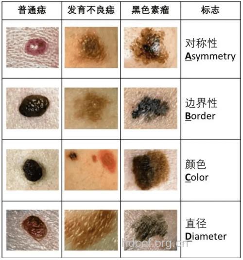 小心黑痣变恶性肿瘤