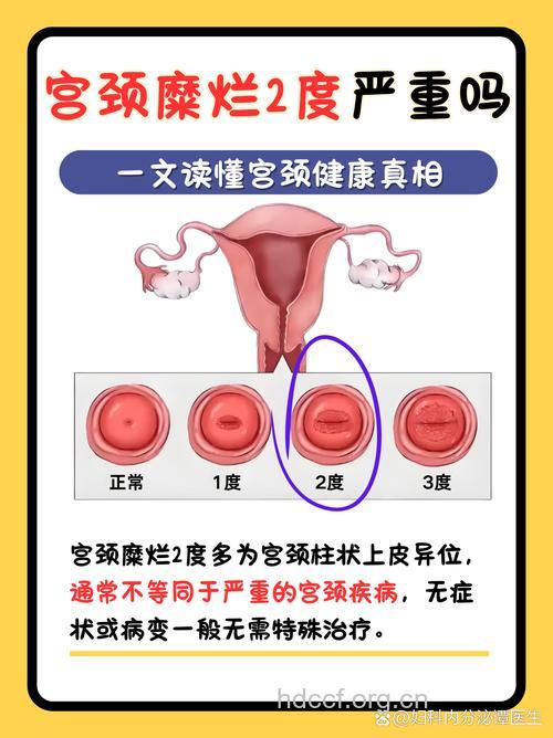 宫颈糜烂会致癌吗
