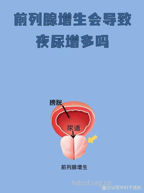 男性前列腺增生为什么要检查尿流率