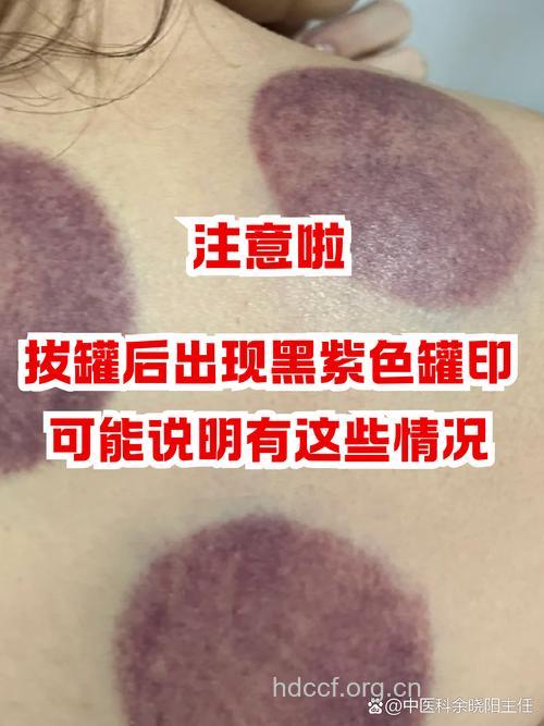 拔火罐后留下的紫印子怎么办