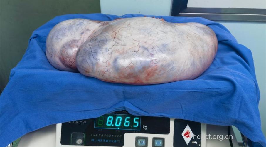 与生孩子有关的肿瘤