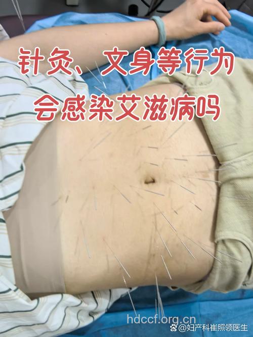 针灸会携带艾滋病病毒吗