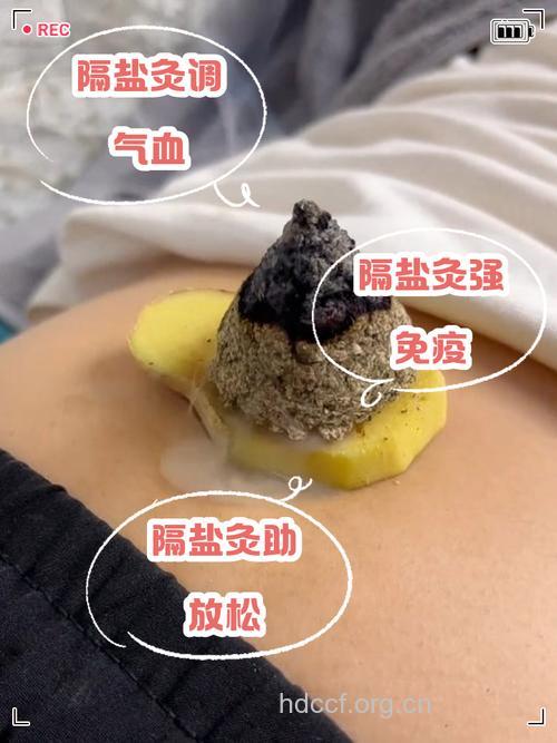 艾炷隔盐灸让你脾健胃和