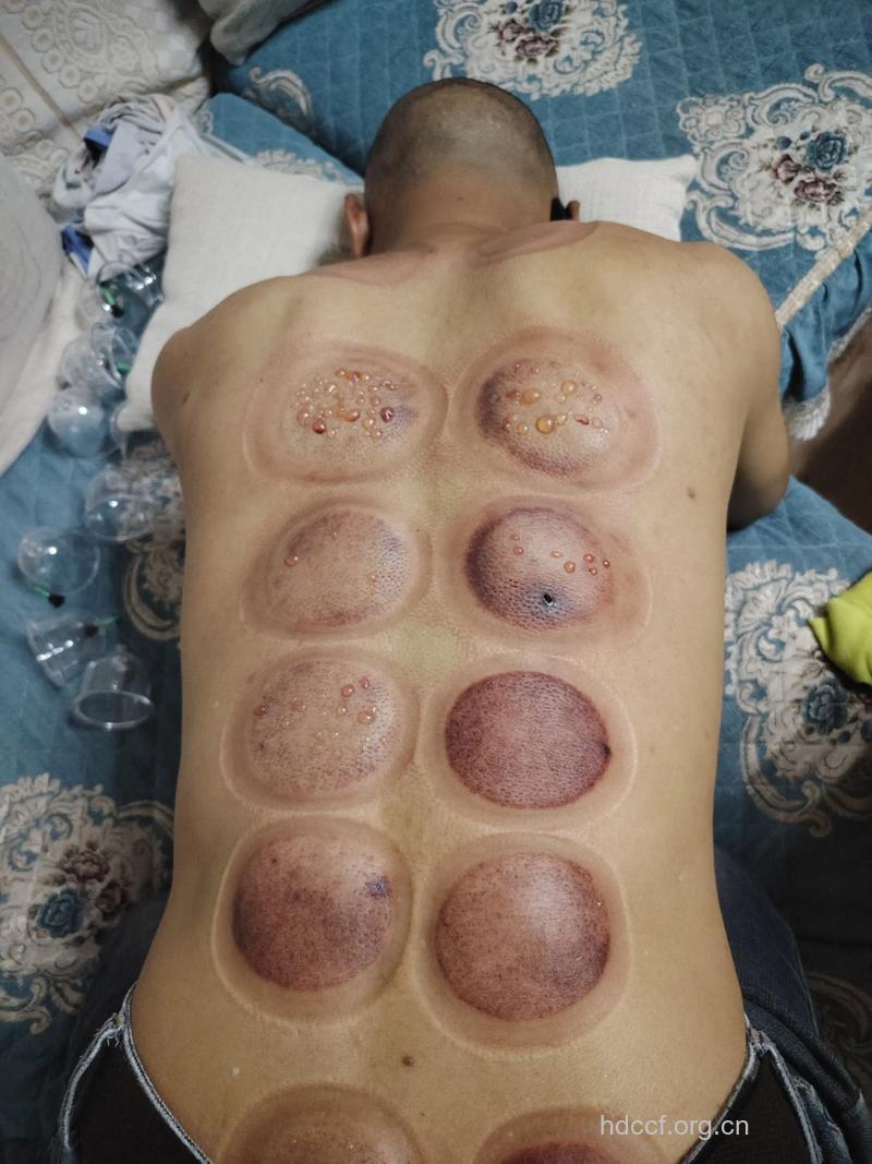 拔罐会出现哪些症状？