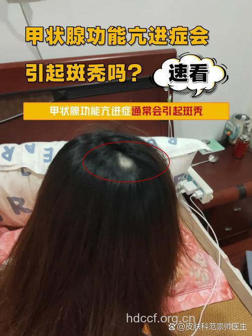 甲状腺异常会不会导致脱发