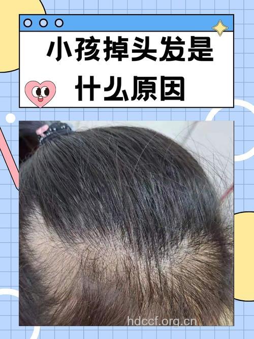 儿童脱发背后是哪些原因造成的