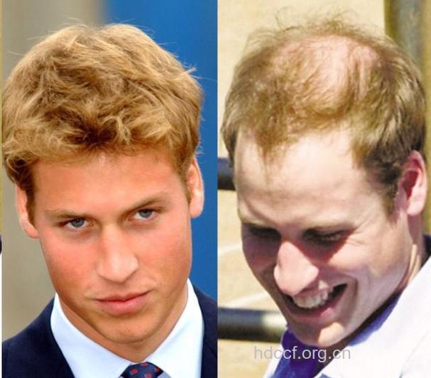 肥胖会导致出现脱发现象