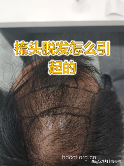 用力梳头会导致脱发吗