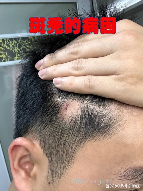 斑秃会导致脱发吗