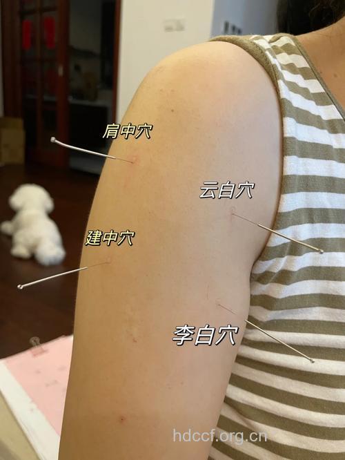 中医针灸如何辨治尿道炎