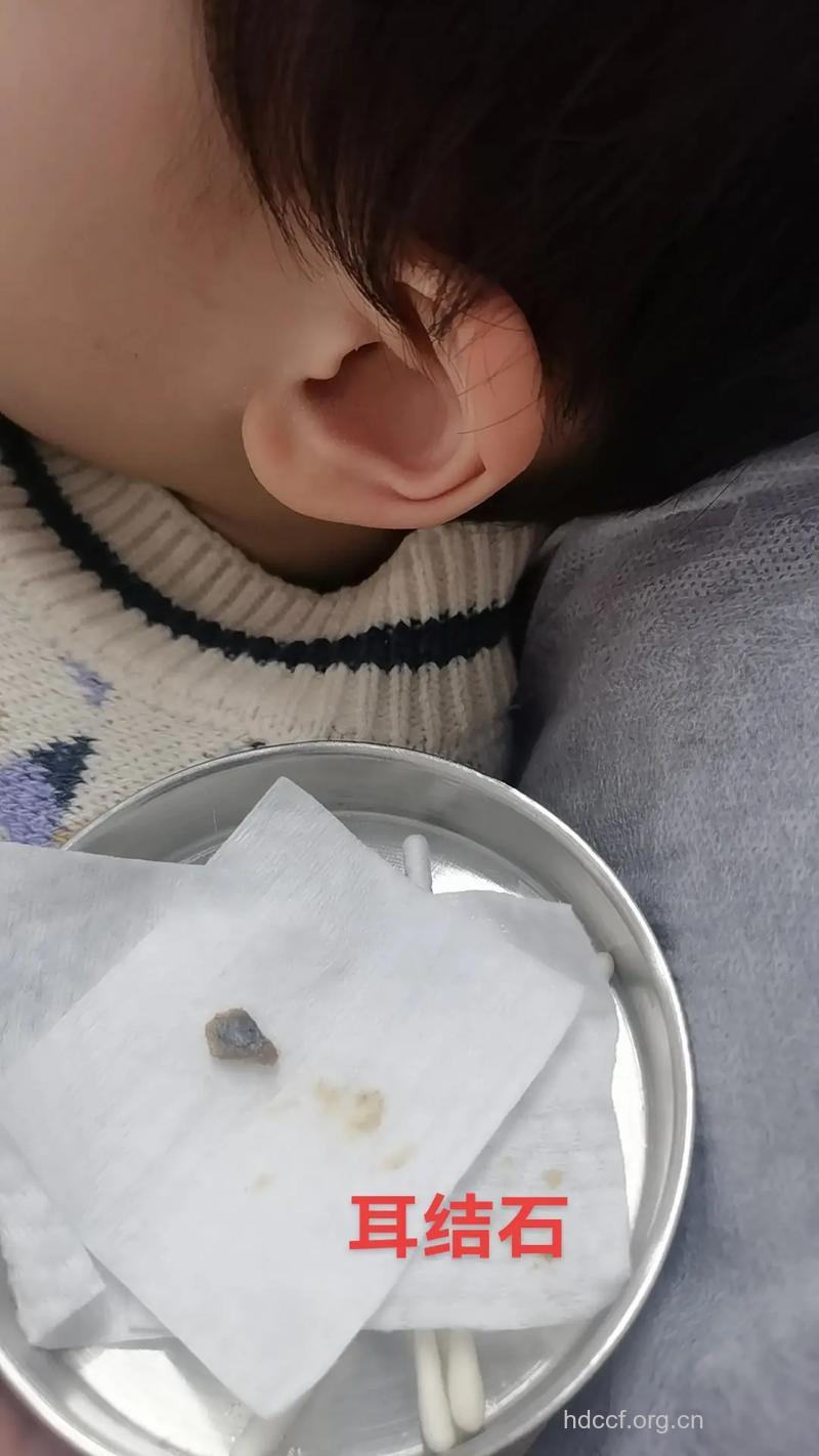 耳穴贴压轻松排出小结石