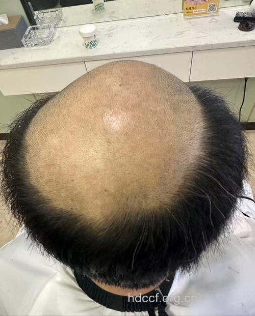 男性脱发遗传性强