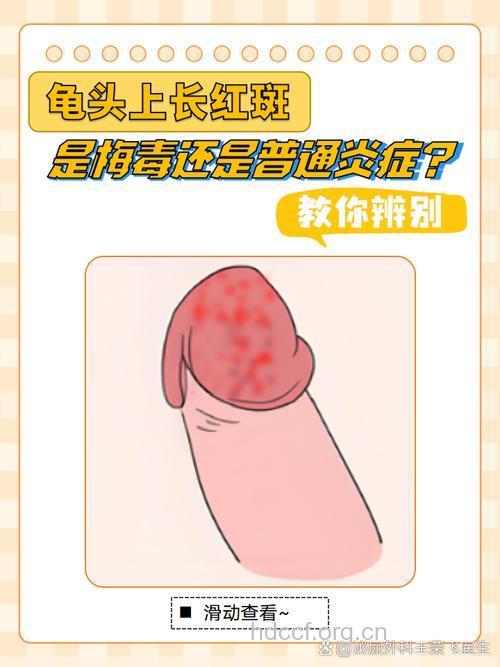 男人该怎么查有没有得性病