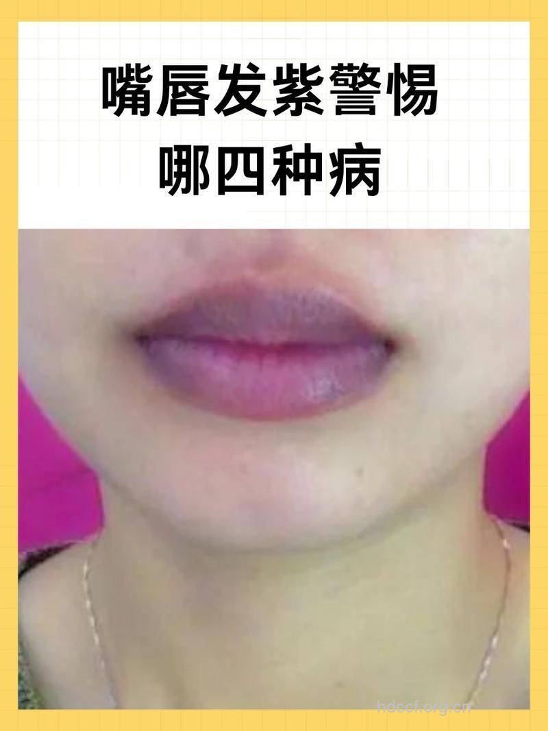 唇色反应健康 嘴唇发紫预示着这些问题