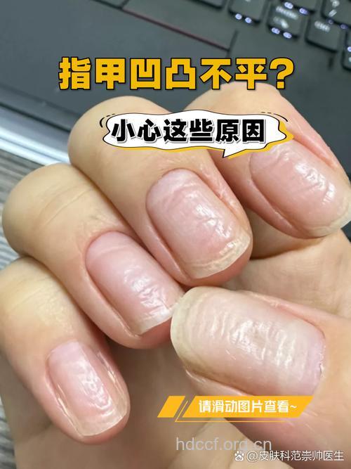 手指甲凹凸怎么回事 主要有三个原因