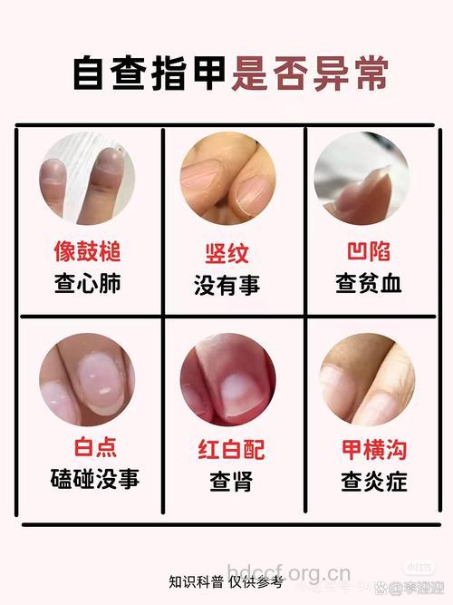 指甲上出现竖纹 三个原因会导致