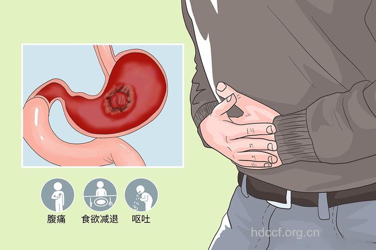 长期熬夜易诱发胃癌