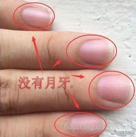 指甲上没有半月痕代表什么