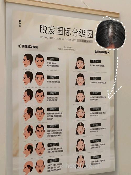 脱发的类型与体质有关