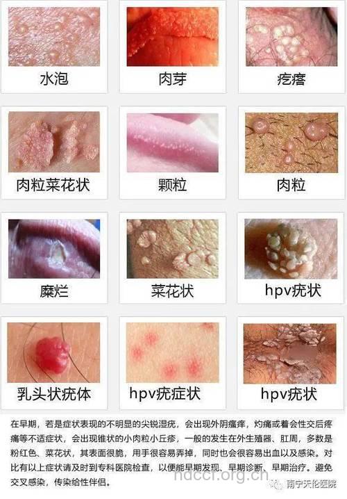 女人性病不易查 私处异常要当心