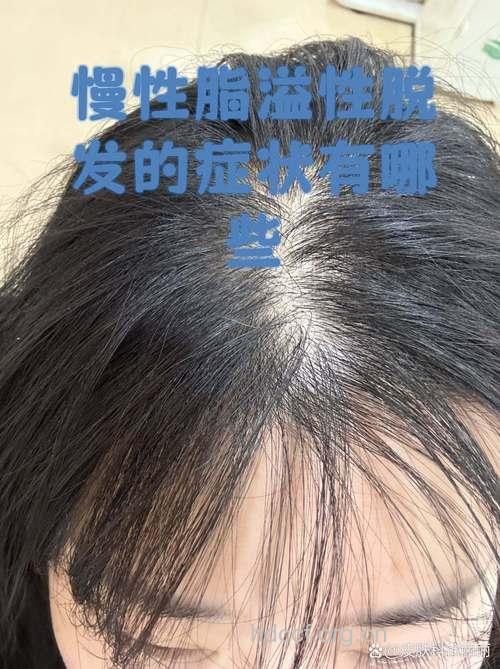 溢脂性脱发有哪些特点