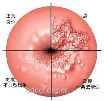 生殖器官癌症与性病的区别