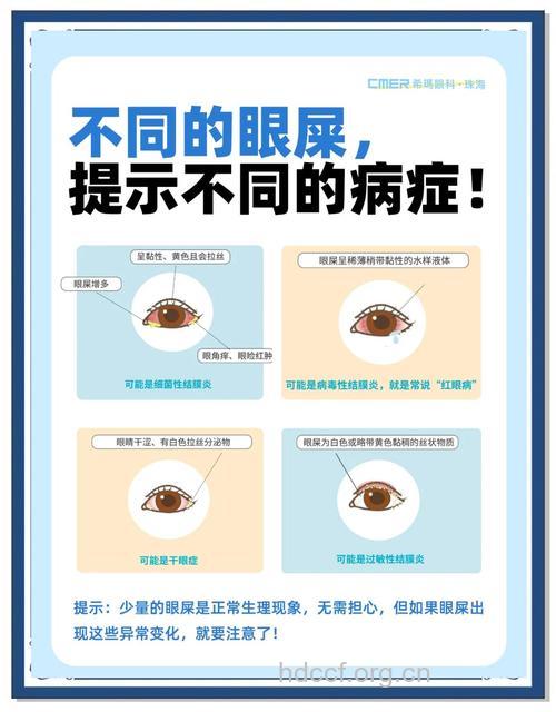 四种异常“眼屎” 提醒眼睛生病了