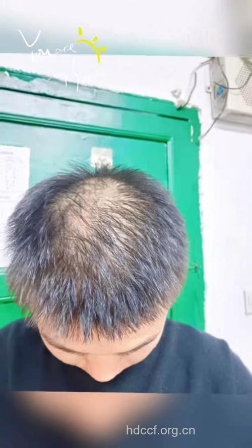 男性多为脂溢性脱发但不易致全秃