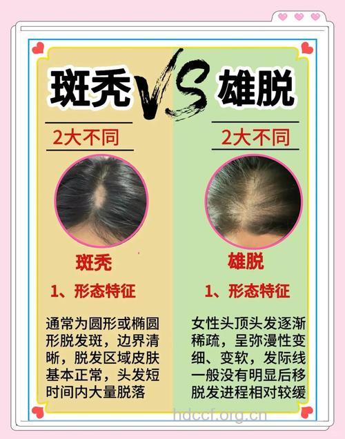 容易与脱发混淆de疾病都有哪些?