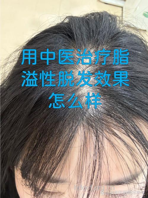 治疗脱发 生发药还是植发？