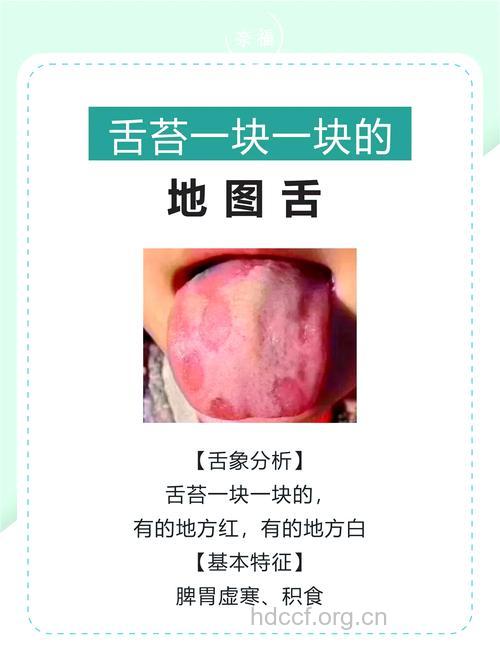 宝宝地图舌怎么办 宝宝地图舌治疗