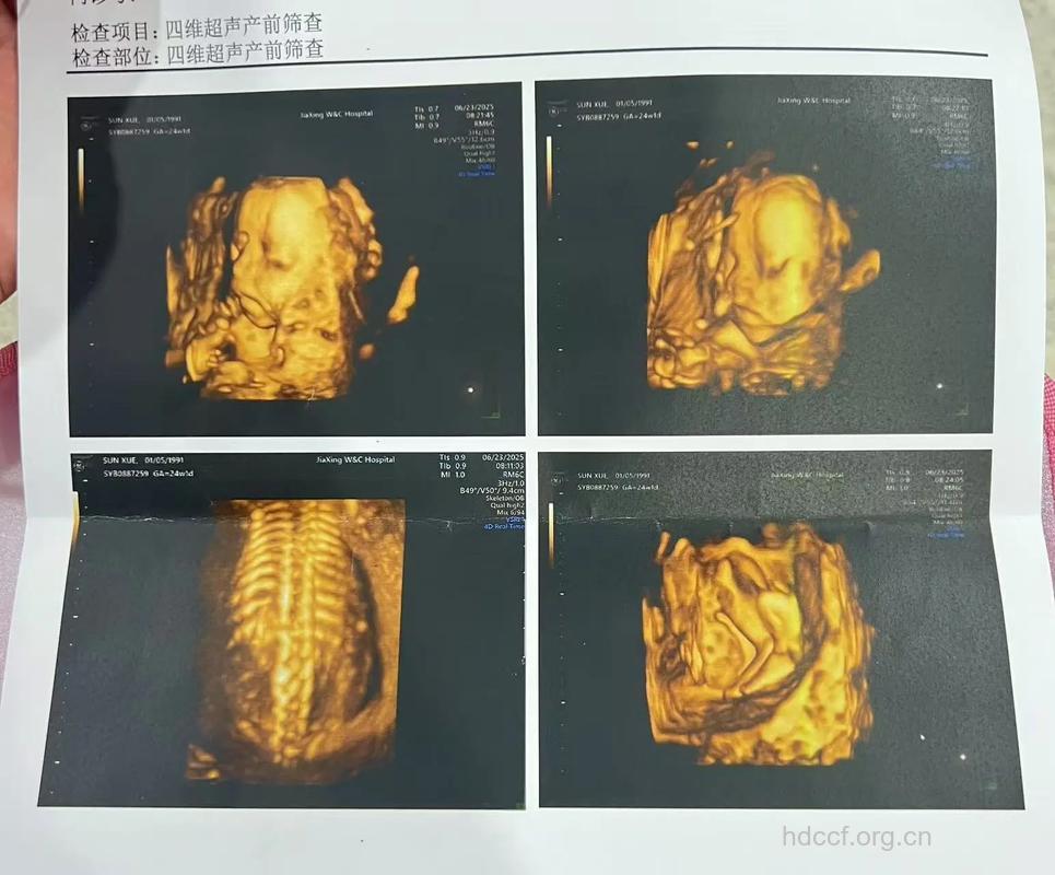 四维彩超能看出宝宝性别吗