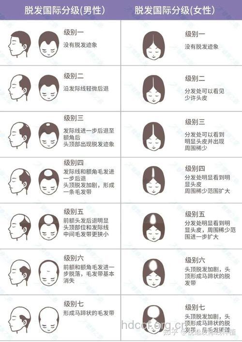 脂溢性脱发的表现和分类