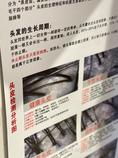 脱发需要做哪些检查？