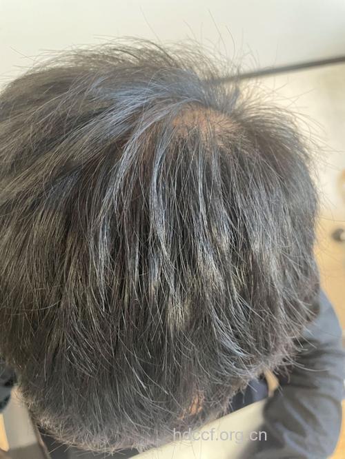 男性健身过度易脱发