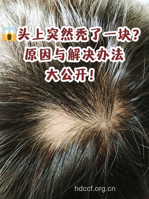 惊!精神因素竟能导致斑秃
