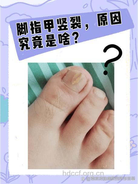 从脚看健康 脚趾下陷指甲易碎是贫血