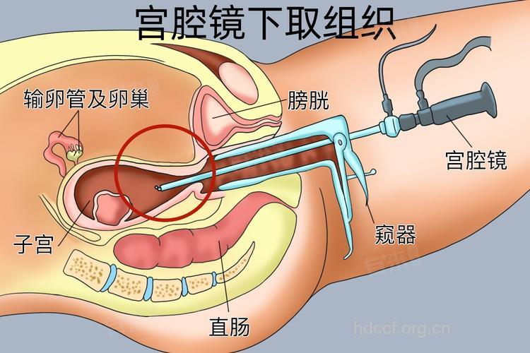 怎么进行子宫镜方法