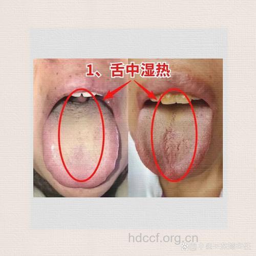 从舌苔看疾病 舌苔黄腻为湿热