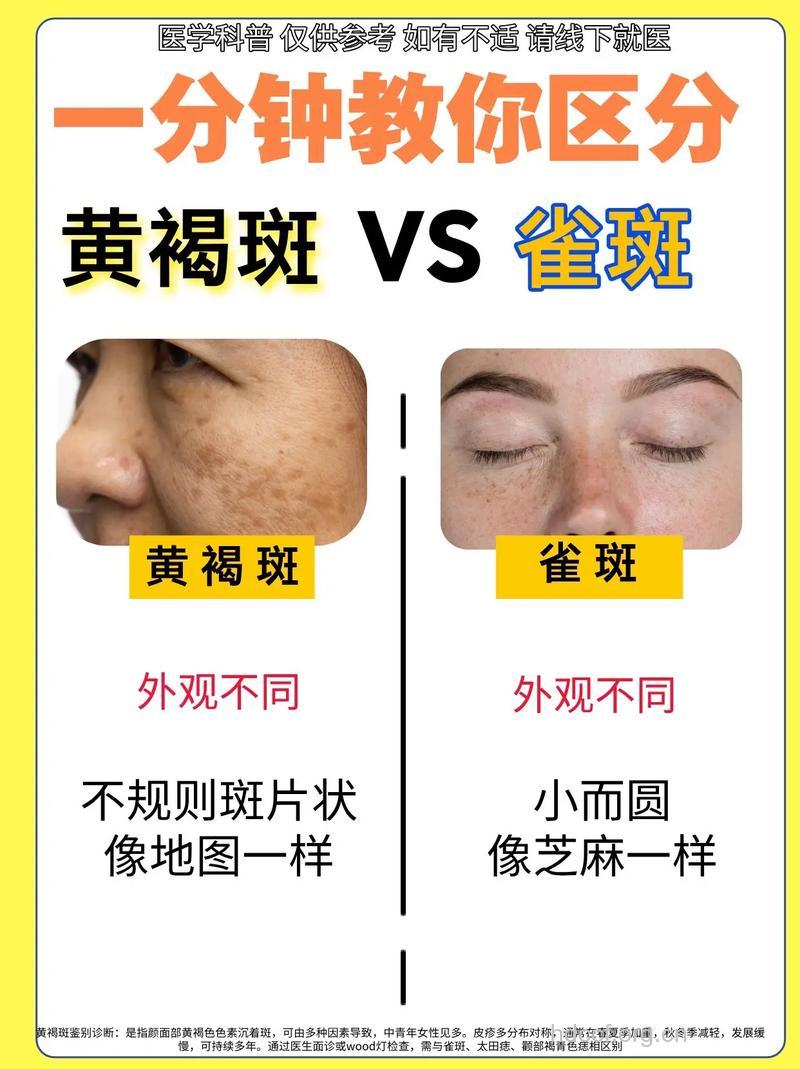 黄褐斑和雀斑有什么区别