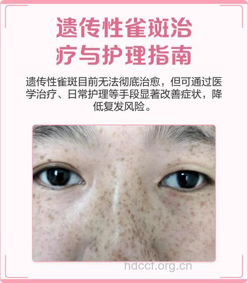 遗传性雀斑怎么祛除