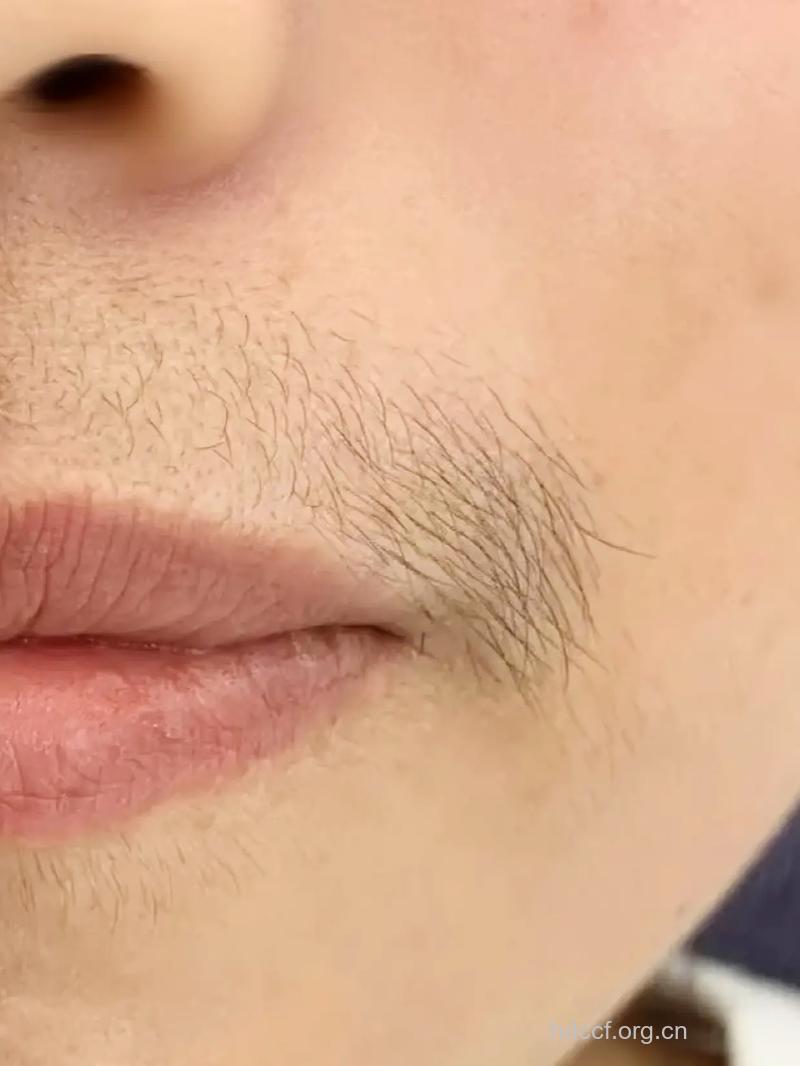 女人长胡子该检查什么?